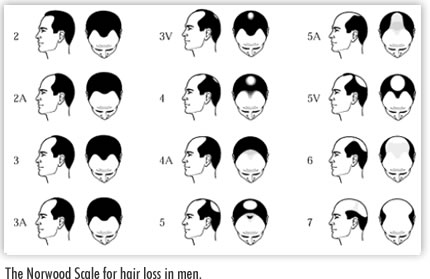 Norwood scale for male hair loss