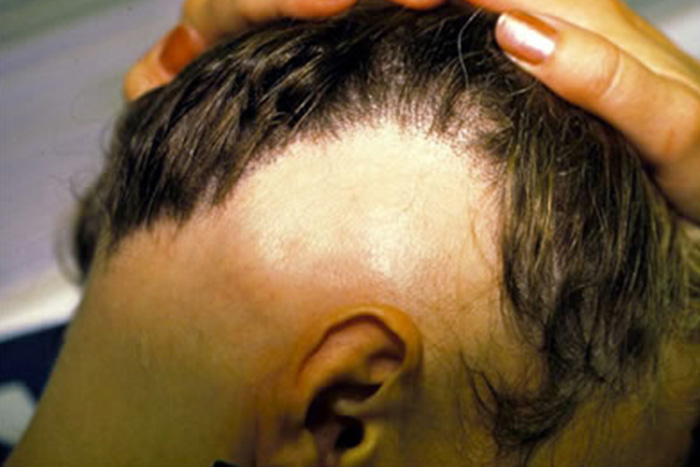 Hair loss solutions