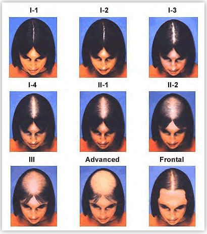 women's hair loss chart