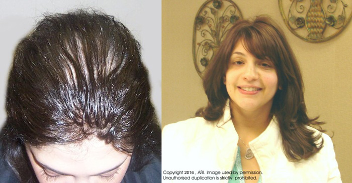 before and after of woman receiving hair loss solution