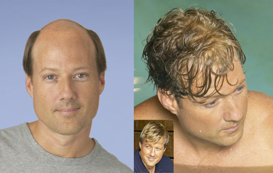 before and after of man receiving hair loss solution