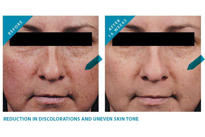 reduction in discoloration after treatment