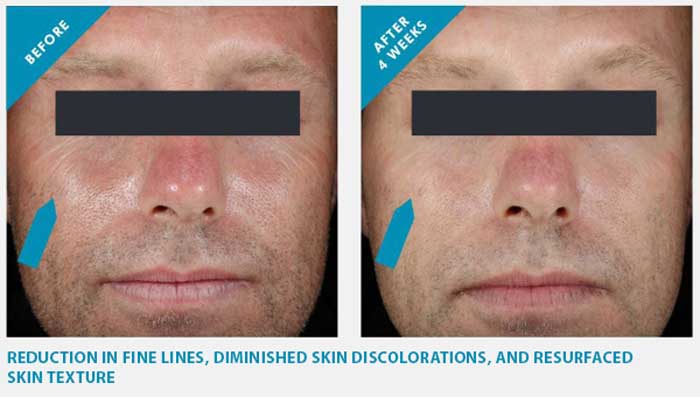 reduction in fine lines and wrinkles after treatment
