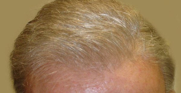 after image of man receiving hair loss solution