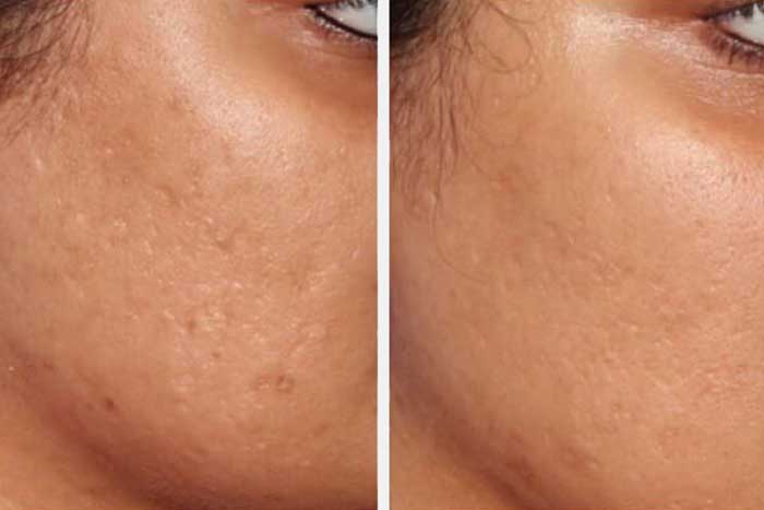 acne scars before and after