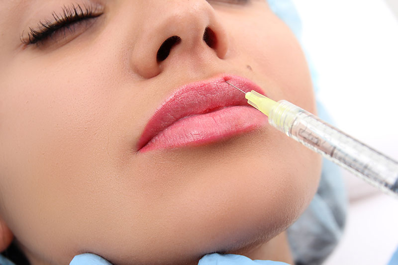 lipfiller
