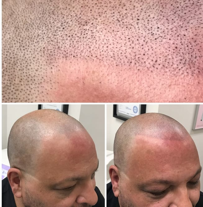 Scalp Micro Pigmentation in Toronto, ON, by FREEDOMclinic