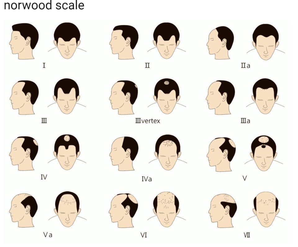 Types of Hair Loss in Toronto, ON by FREEDOMclinic