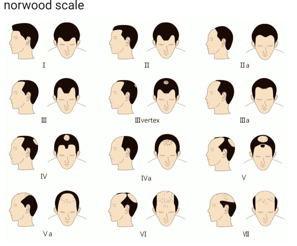 Male Pattern Baldness Hair Loss  Causes  Treatment