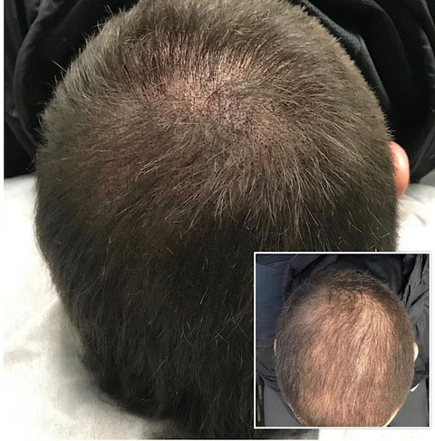 Scalp Micro Pigmentation in Toronto, ON, by FREEDOMclinic