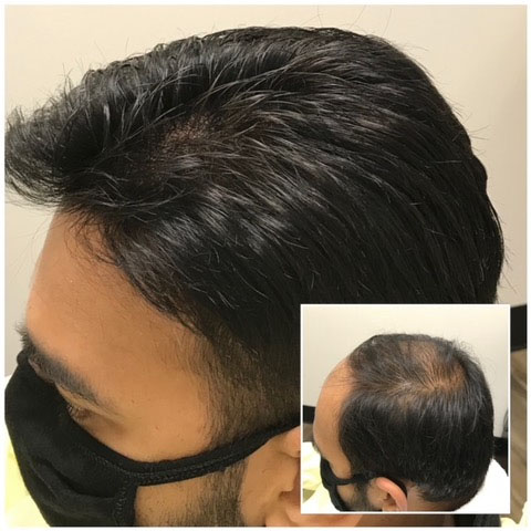 Non-Surgical Hair Loss Solution in Toronto by FREEDOMclinic