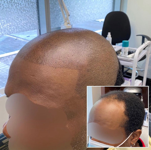 Scalp pigmentation