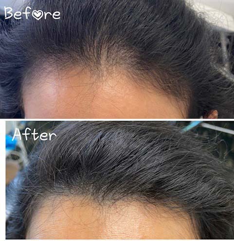 PRP & PRF Treatments Before and After Photos Melbourne, FL