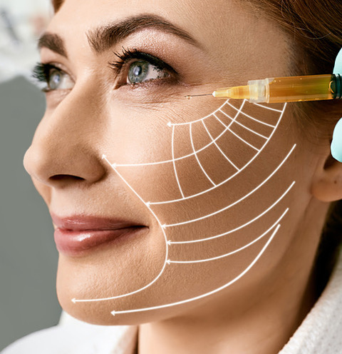 Middle-aged woman with lifting arrows on her face during plasma therapy