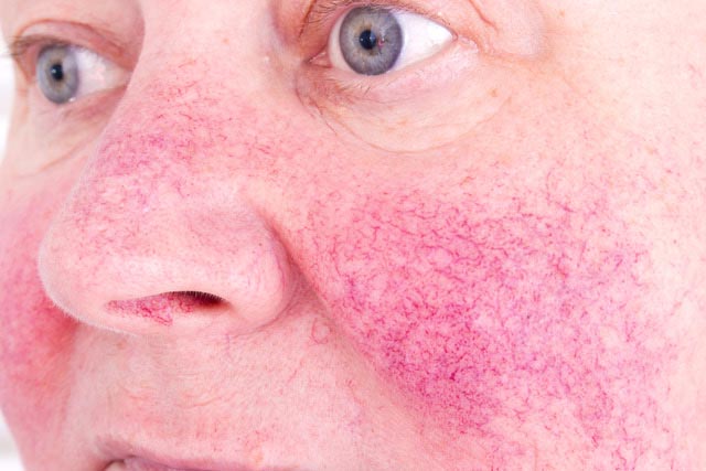 Unhappy,Elderly,Woman,With,Skin,Condition,Rosacea,Characterized,By,Facial