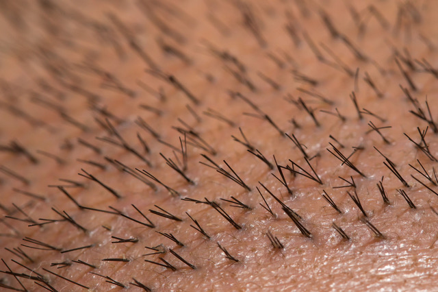 FUE Extraction services in Toronto, ON