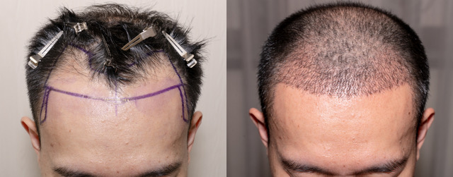 Follicular Unit Transplant in Toronto, ON