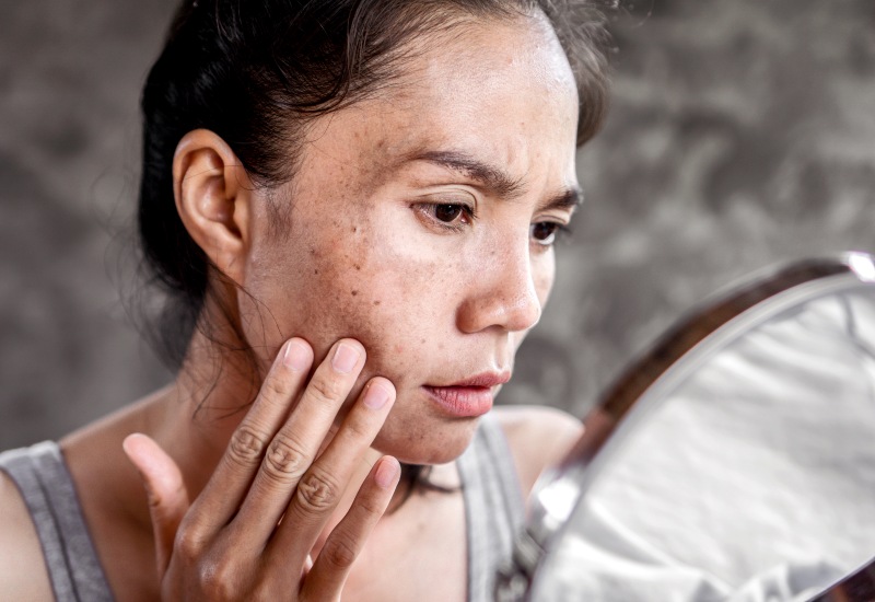 Pigmented Lesions in Toronto