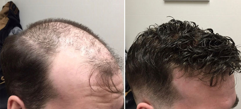 Before-and-after comparison showing hair thinning and fuller restored hairstyle.