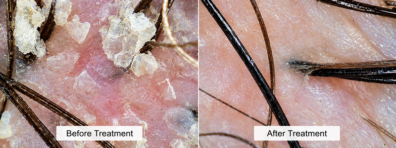 Before After treatment