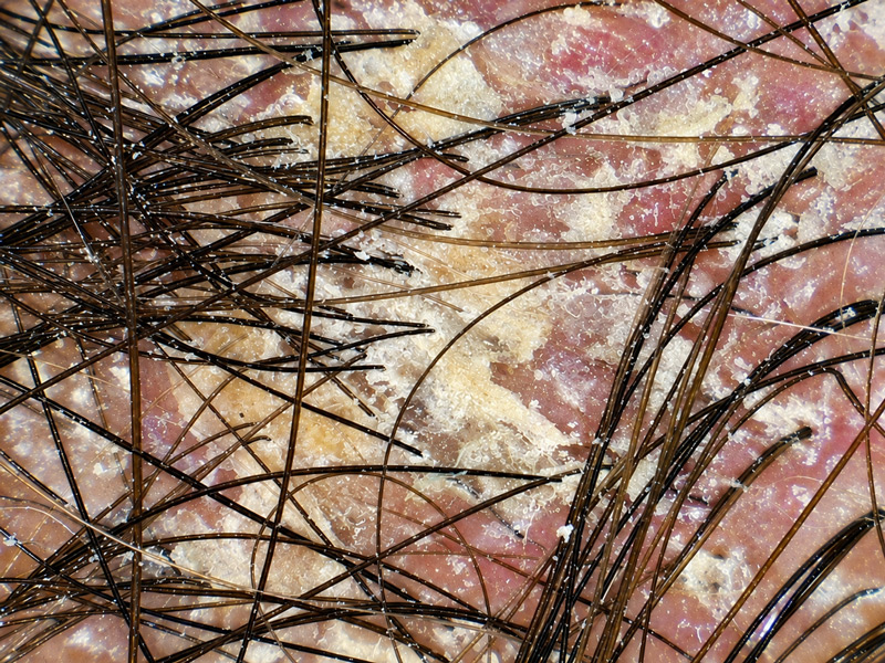 Seborrheic dermatitis may cause increased sebum, inflammation and scaling around the hair follicles.